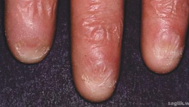 Diskeratozis Konjenita