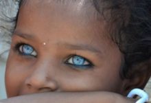 Waardenburg Sendromu