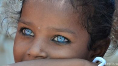 Waardenburg Sendromu