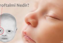 Mikroftalmi Nedir?