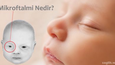 Mikroftalmi Nedir?