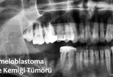 Ameloblastoma Nedir?