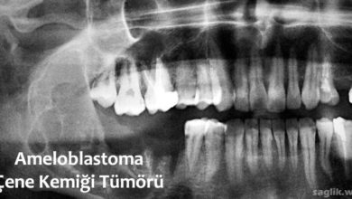 Ameloblastoma Nedir?