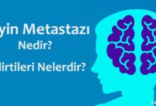 Beyin Metastazı Nedir?