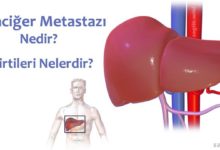 Karaciğer Metastazı Nedir?
