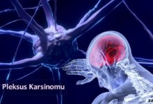 Koroid Pleksus Karsinomu