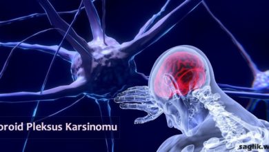 Koroid Pleksus Karsinomu