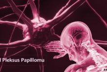 Koroid Pleksus Papillomu