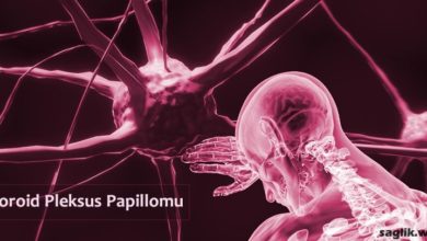 Koroid Pleksus Papillomu