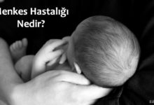 Menkes Hastalığı (Menkes sendromu)