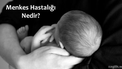 Menkes Hastalığı (Menkes sendromu)