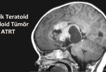 Atipik Teratoid Rabdoid Tümör Nedir?