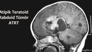 Atipik Teratoid Rabdoid Tümör Nedir?