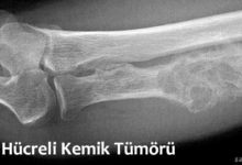 Dev Hücreli Kemik Tümörü