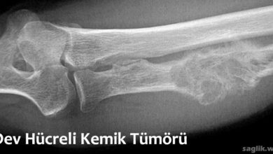 Dev Hücreli Kemik Tümörü