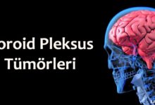 Koroid Pleksus Tümörleri