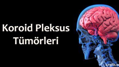 Koroid Pleksus Tümörleri