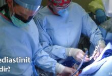 Mediastinit Nedir?