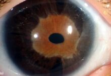 Axenfeld-Rieger Sendromu Nedir?