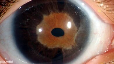 Axenfeld-Rieger Sendromu Nedir?