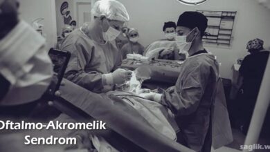 Oftalmo-Akromelik Sendrom Nedir?