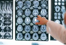 Dekompresif Kraniektomi Nedir?