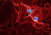 ZAP70 İle İlişkili Şiddetli Kombine İmmün Yetmezlik