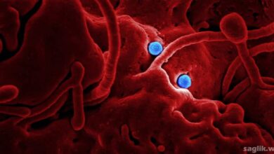 ZAP70 İle İlişkili Şiddetli Kombine İmmün Yetmezlik