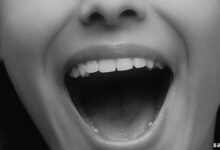 Ağız Tabanı Kanseri