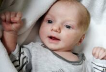 Bebek Sivilcesi (Aknesi)