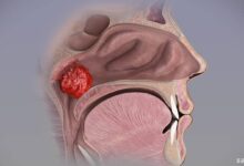 Geniz Eti (Adenoid) Nedir?